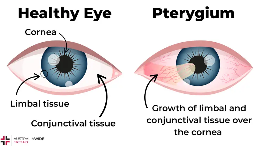 pterygium graphic
